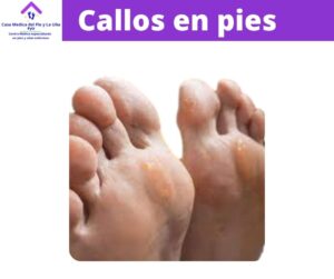 www.casamedicadelpieylauña.com 2 pies con callos