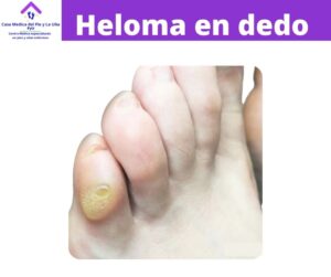 www.casamedicadelpieylauña.com heloma en dedo del pie
