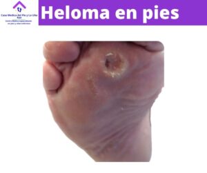www.casamedicadelpieylauña.com heloma en planta del pie