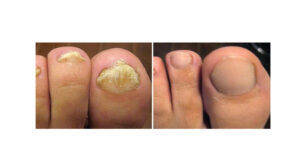 tratamiento laser para pies y uñas , tratamiento laser para uñas con hongos 2