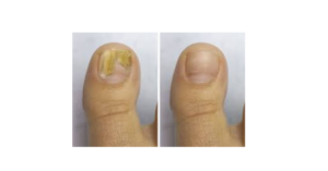 tratamiento laser para pies y uñas , tratamiento laser para uñas con hongos 3