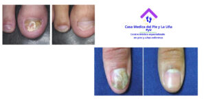 tratamiento laser para uñas con hongos, casamedicadelpieylauña