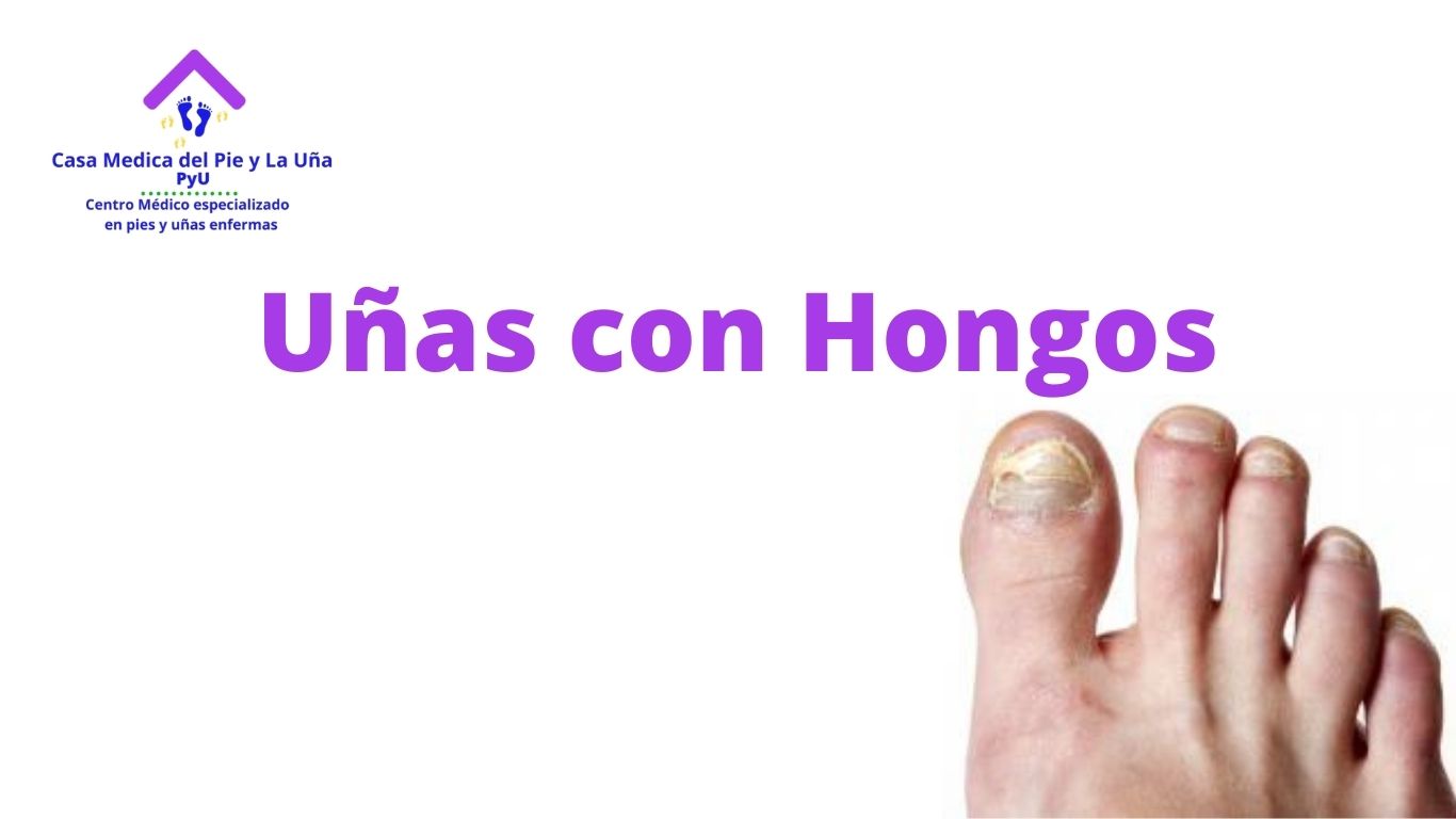 Uñas con hongos - Casa Medica del Pie y La Uña