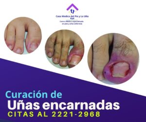 Uñas Encarnadas - Casa Medica del Pie y La Uña